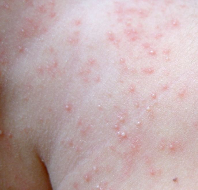 什么是痱子科普小知识,治疗严重痱子11个小偏方