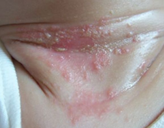 什么是痱子科普小知识,治疗严重痱子11个小偏方