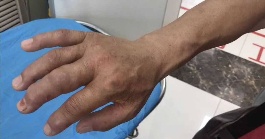 被毛毛虫蛰了手红了,被毛毛虫蜇到手