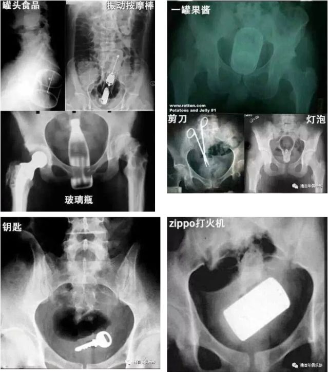 菊花一紧！男子洗澡摔倒，面霜棒插入肛门！进去容易出来难…
