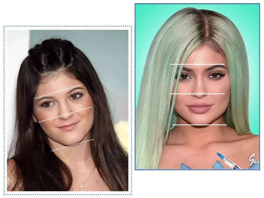 泫雅丰唇后颜值下跌？！但大家都爱这样的“香肠嘴”啊