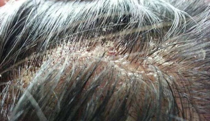 头皮发痒爱出油是什么引起的,头皮出油严重痒是什么原因引起的