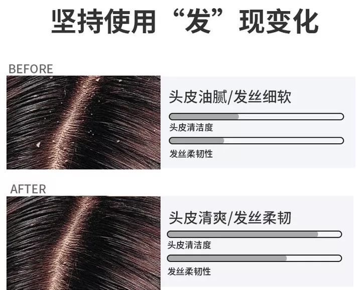 头皮发痒爱出油是什么引起的,头皮出油严重痒是什么原因引起的