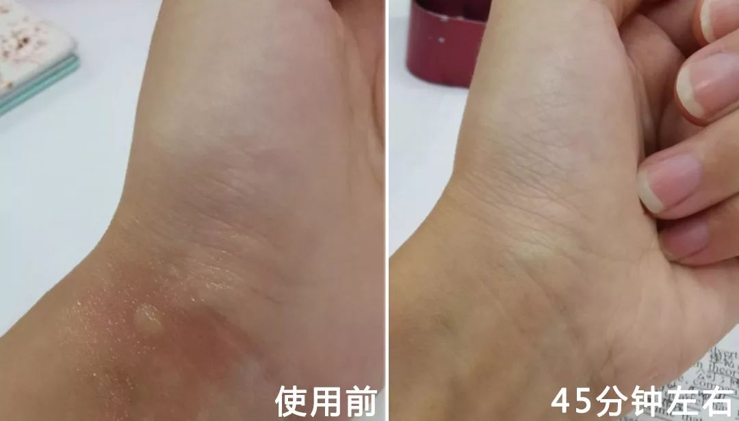 一小瓶止痒的药膏,一小瓶药水止痒叫什么