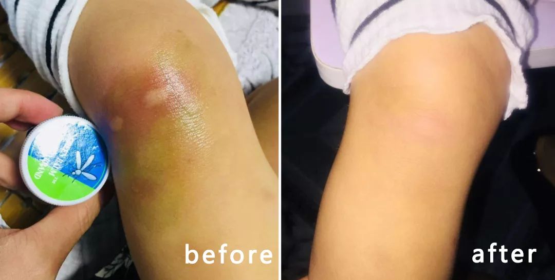 一小瓶止痒的药膏,一小瓶药水止痒叫什么