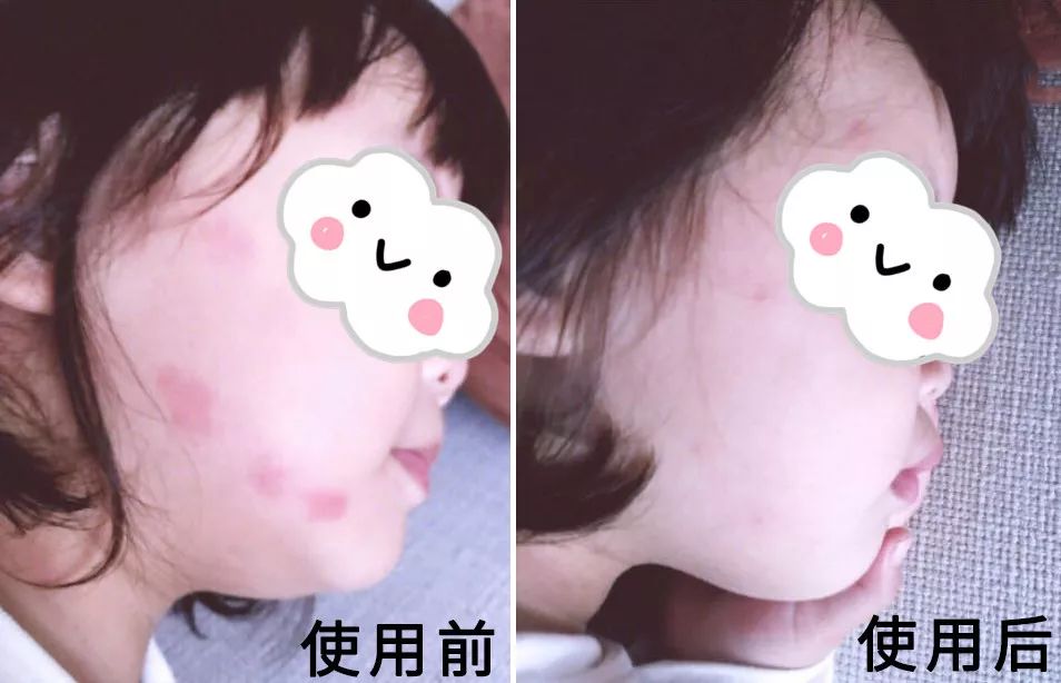 一小瓶止痒的药膏,一小瓶药水止痒叫什么