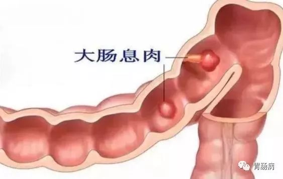 胃溃疡直肠息肉挂什么科,结肠直肠多发息肉看什么科