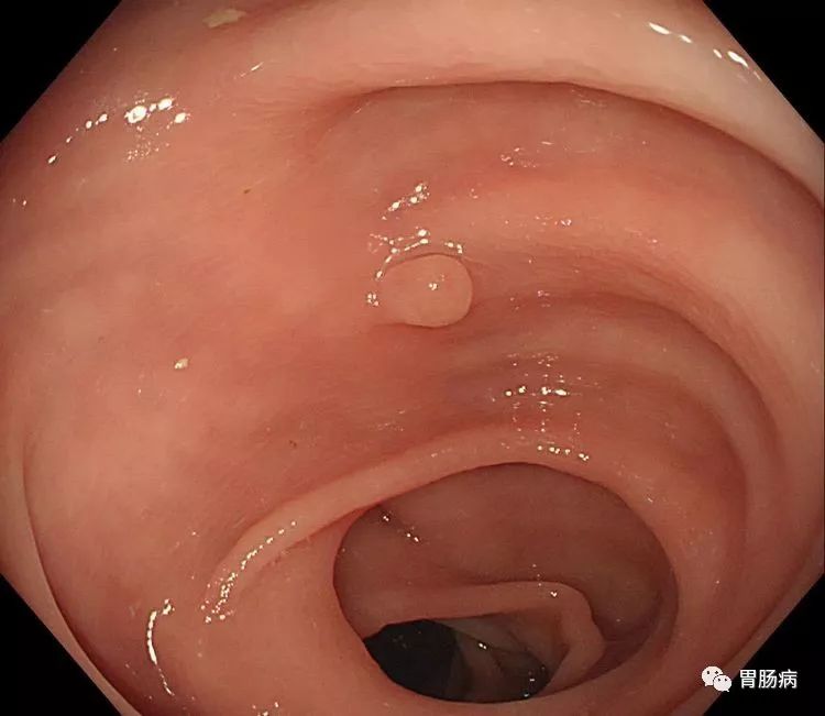 胃溃疡直肠息肉挂什么科,结肠直肠多发息肉看什么科