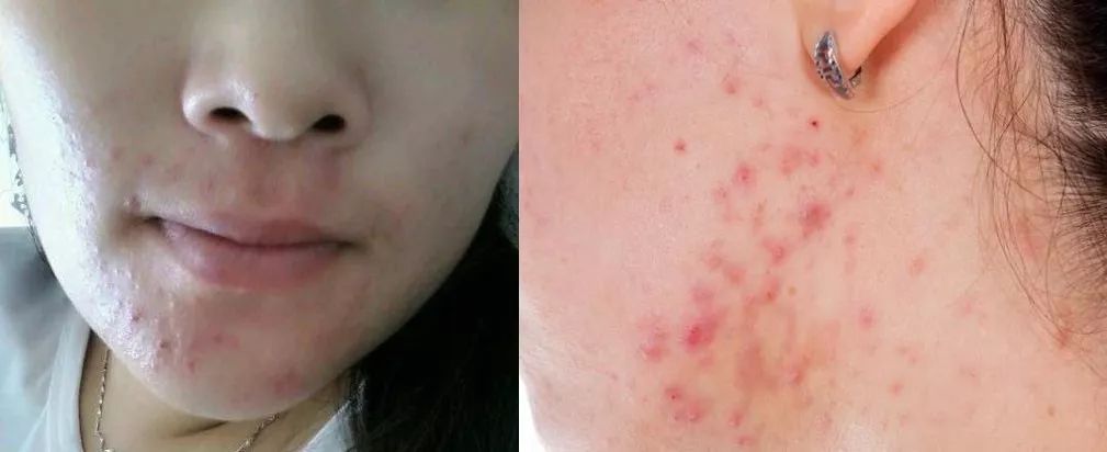 除螨虫杀菌喷雾持久留香,无线除螨仪紫外线杀菌去螨虫神器