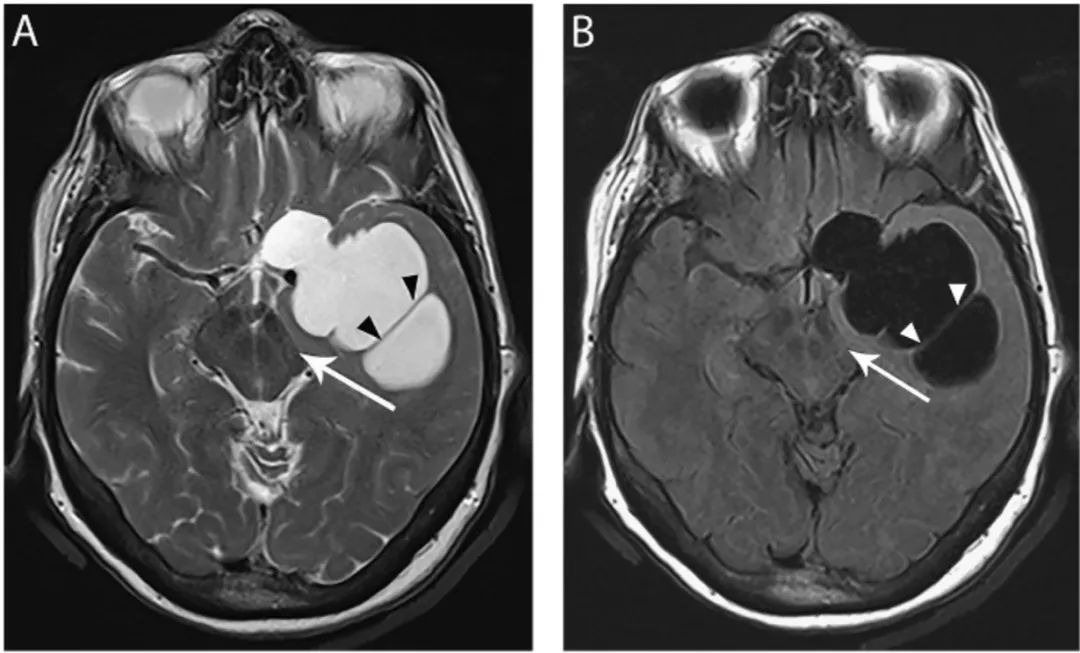 多图多表：带你识别颅内囊肿的影像学表现丨实战读片