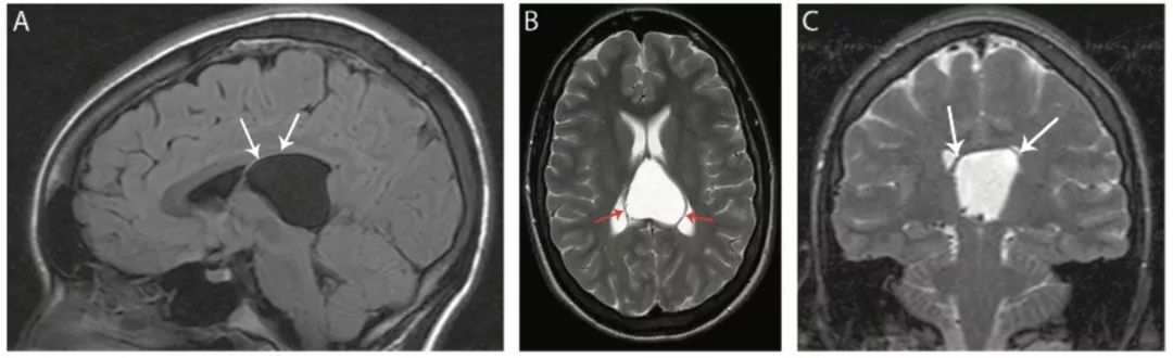 多图多表：带你识别颅内囊肿的影像学表现丨实战读片