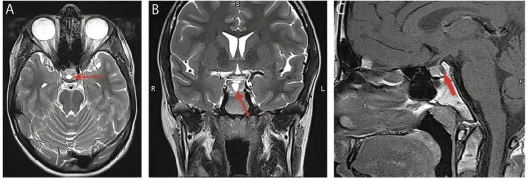 多图多表：带你识别颅内囊肿的影像学表现丨实战读片