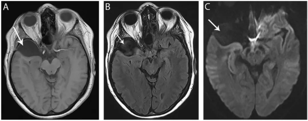 多图多表：带你识别颅内囊肿的影像学表现丨实战读片