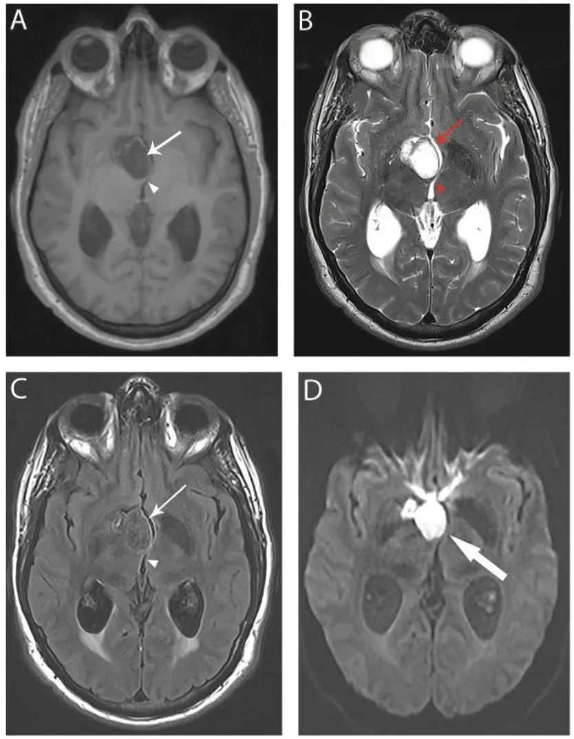多图多表：带你识别颅内囊肿的影像学表现丨实战读片