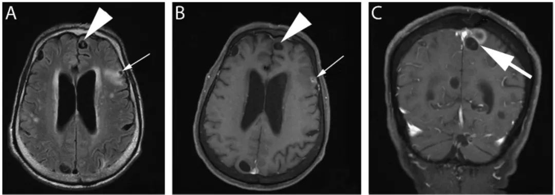 多图多表：带你识别颅内囊肿的影像学表现丨实战读片