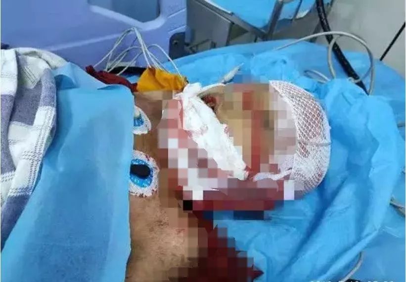 四川小孩被玩伴嘴角撕裂,男童嘴角裂到耳根