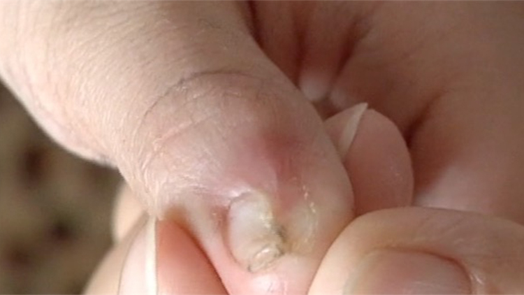 11岁孩子指甲出现溃烂,11岁孩子指甲根部出现溃烂