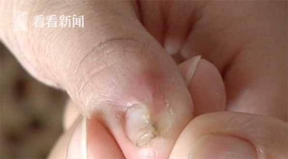 11岁孩子指甲出现溃烂,11岁孩子指甲根部出现溃烂