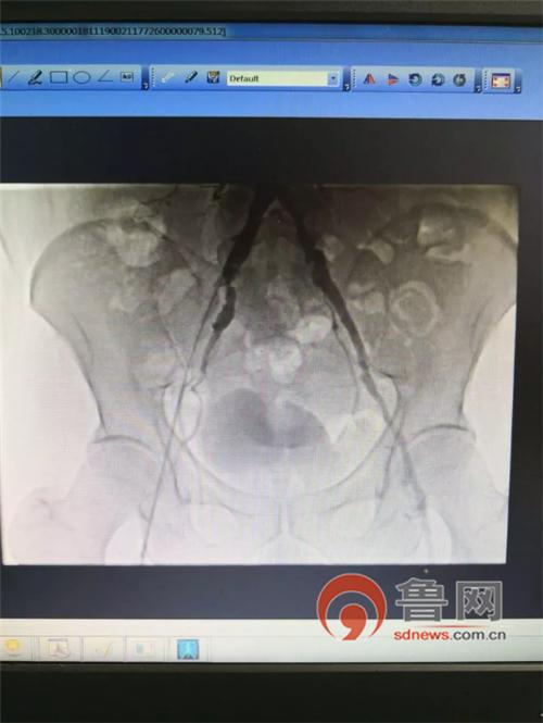 糖尿病医疗突破,糖尿病微创介入