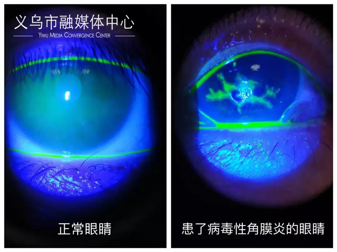 义乌一姑娘，得了病毒性角膜炎！竟然是因为眼药水？