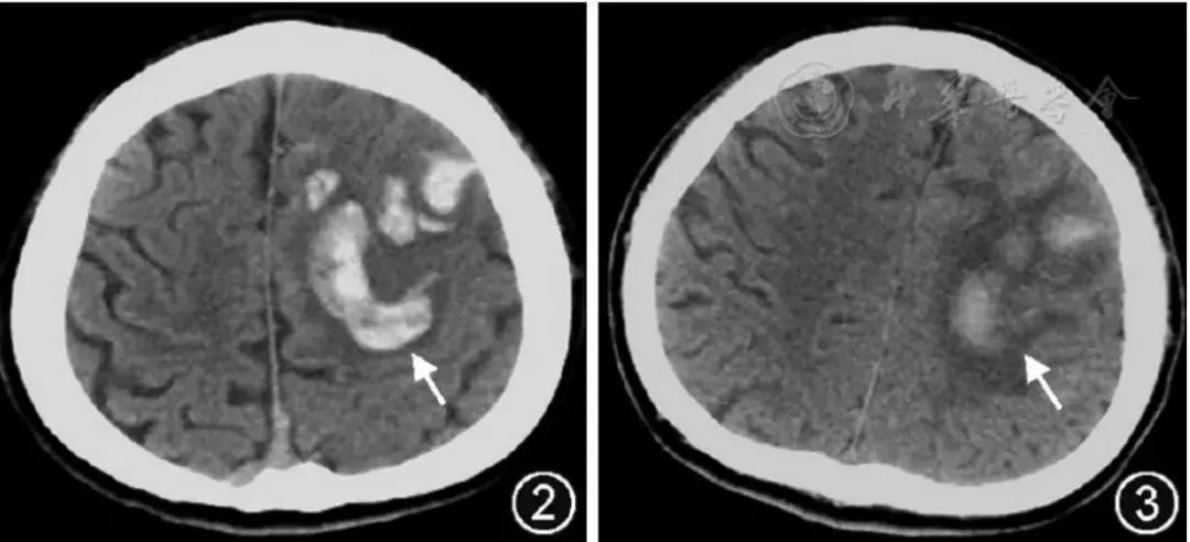 MMA伴cblC型并发ICH、巨细胞病毒脑室脑炎、霉曲菌感染丨3分钟读片·第6期
