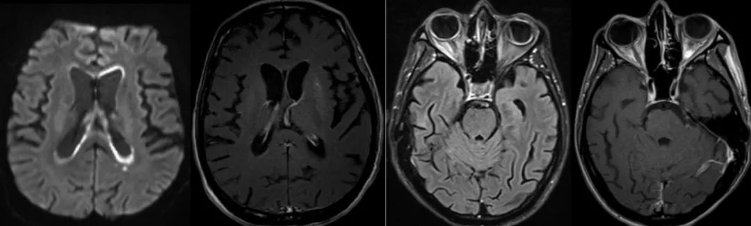 MMA伴cblC型并发ICH、巨细胞病毒脑室脑炎、霉曲菌感染丨3分钟读片·第6期