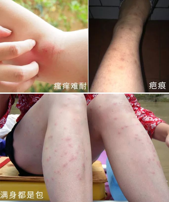 一小瓶止痒的药膏,一小瓶药水止痒叫什么