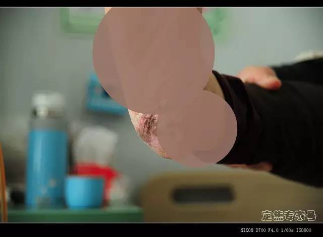 哪个部位的痣会有癌变风险,身体上已有的痣容易癌变吗