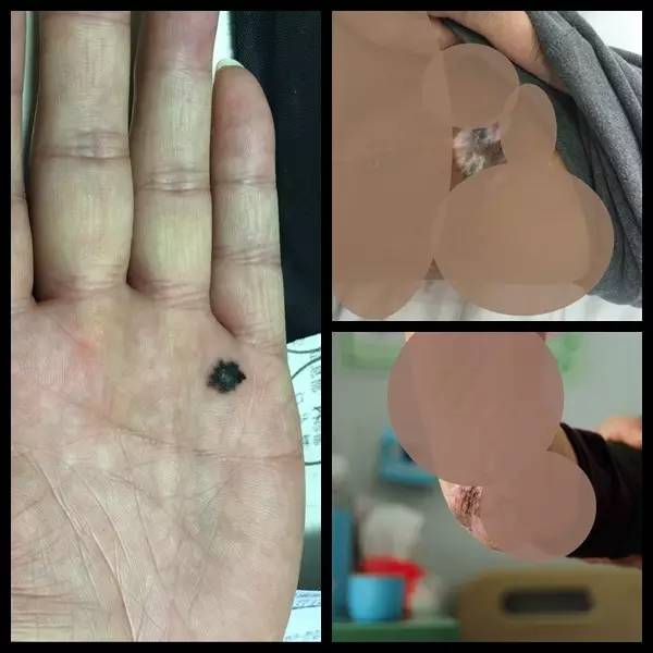 哪个部位的痣会有癌变风险,身体上已有的痣容易癌变吗