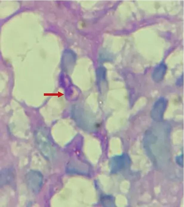 肝病核心力量锻炼,肝病引起脾肿大怎么治