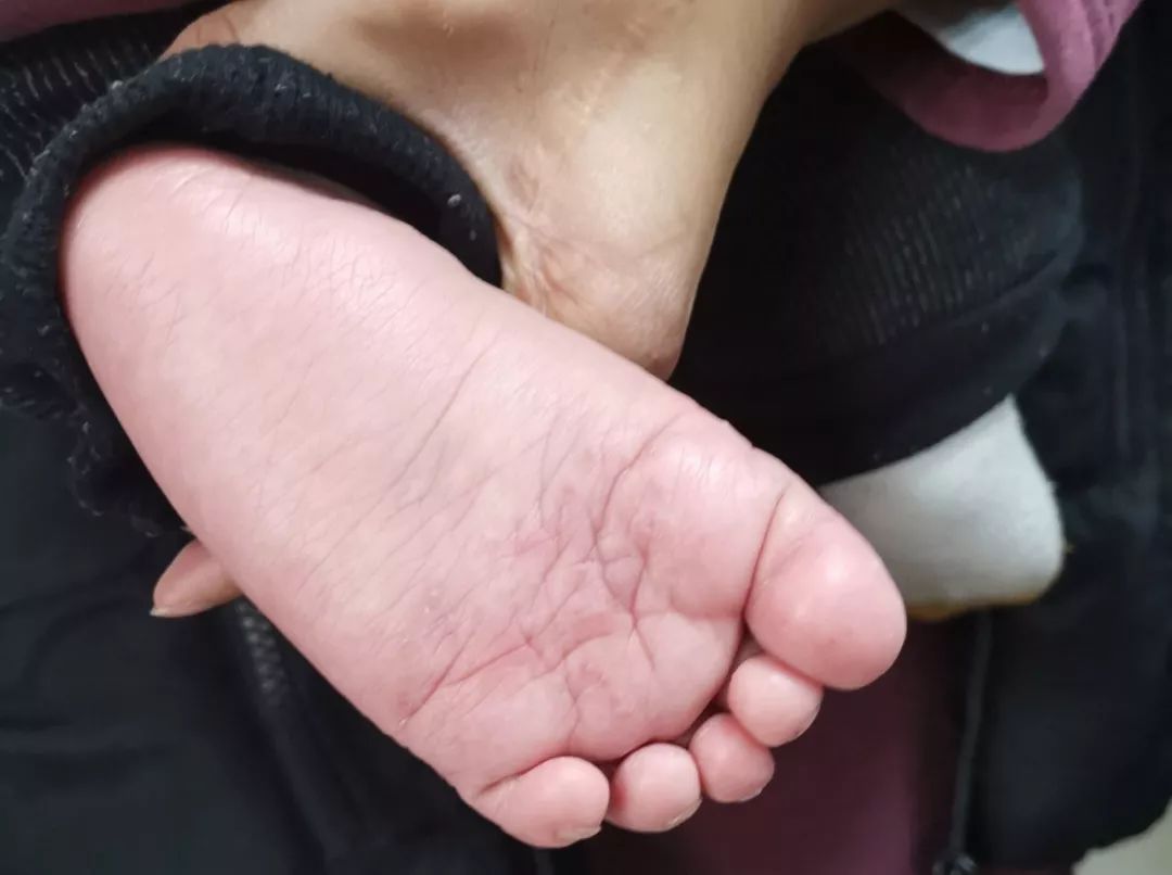 鍏釜鏈堢殑瀹濆疂鑴氫細鎬庢牱,8涓湀瀹濆疂鑴氶兘鏄箍鐤瑰悧