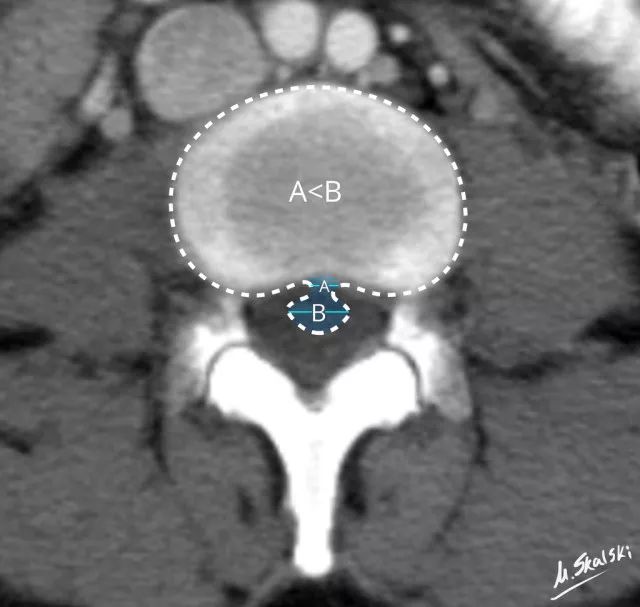 椎间盘膨出脱出图解,椎间盘膨出脱出和突出哪个更严重