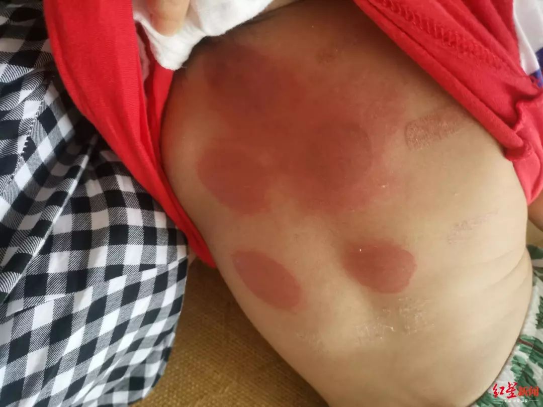 小孩贴三伏贴被烧了,92名儿童贴三伏贴的真相