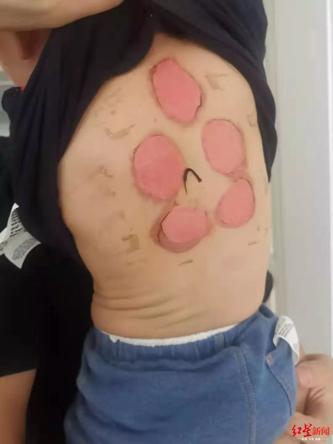 小孩贴三伏贴被烧了,92名儿童贴三伏贴的真相