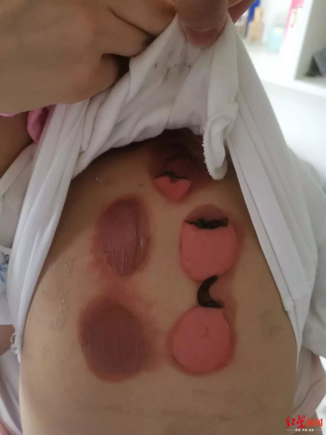 小孩贴三伏贴被烧了,92名儿童贴三伏贴的真相