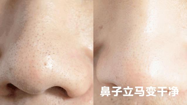 黑头用黑头膏为什么去不掉黑头,清洁黑头推荐用黑头仪还是黑头铲