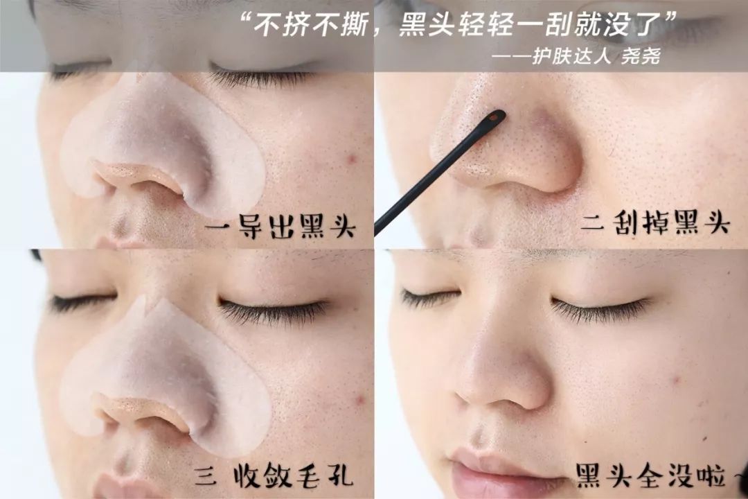 怎样高效快速去黑头,如何快速高效的去黑头