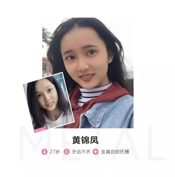 别人矫牙1万起，广州只要3960元！仅限2天