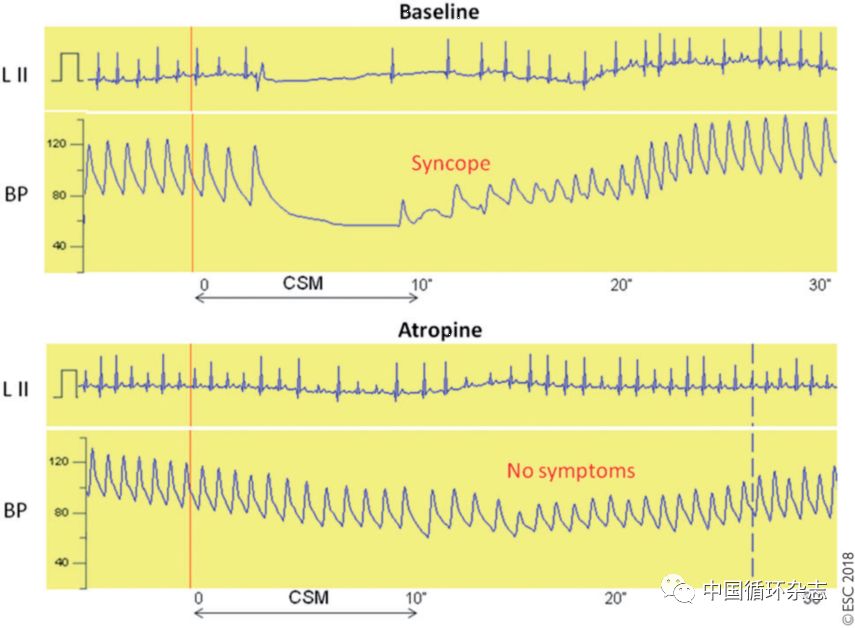 临床上晕厥的预防和处理,2022晕厥诊断与治疗指南