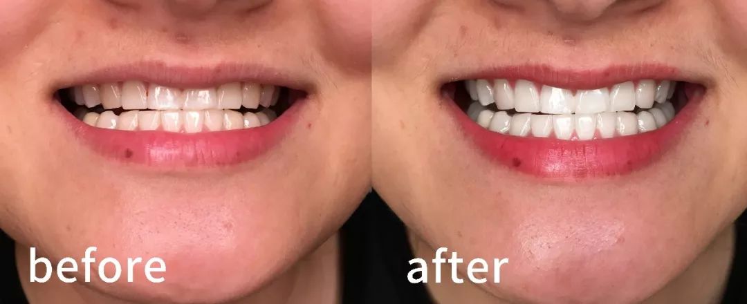 秒除口臭,一秒解决当天口臭