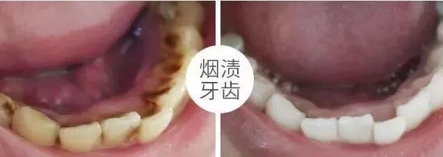 秒除口臭,一秒解决当天口臭