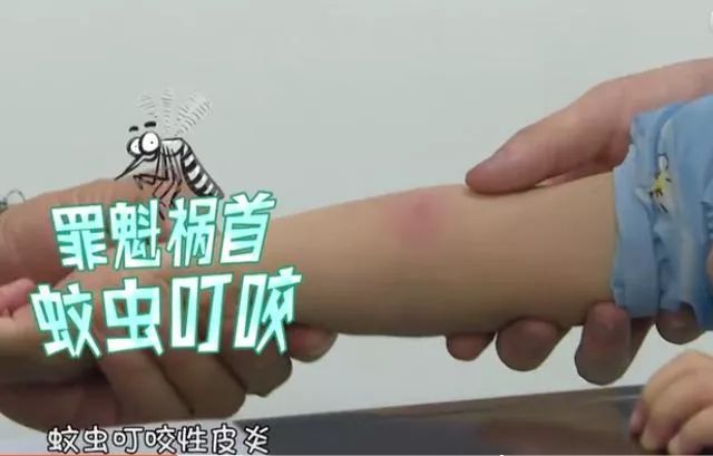 儿童虫咬皮炎科普视频,中医怎么治疗儿童虫咬皮炎