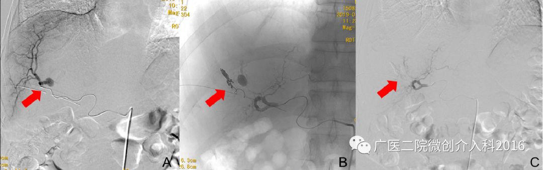出现了吐血吃什么药,吐血又便血是什么病的征兆