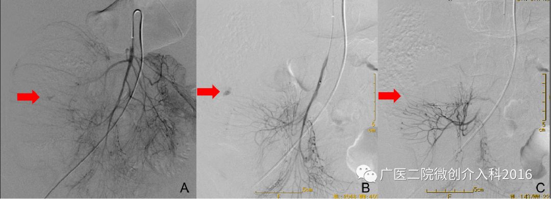 出现了吐血吃什么药,吐血又便血是什么病的征兆