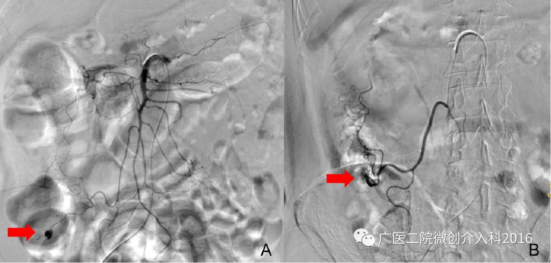 出现了吐血吃什么药,吐血又便血是什么病的征兆