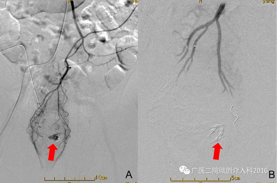 出现了吐血吃什么药,吐血又便血是什么病的征兆