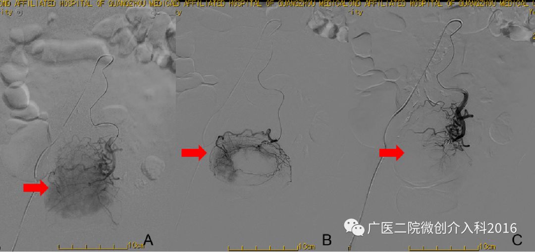 出现了吐血吃什么药,吐血又便血是什么病的征兆