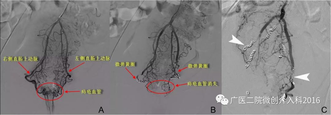 出现了吐血吃什么药,吐血又便血是什么病的征兆