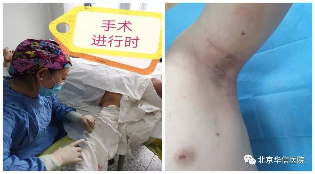 拒绝腋臭,夏天让人尴尬的腋臭该如何应对