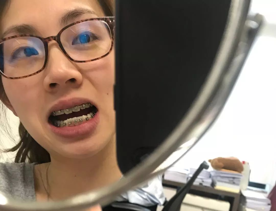 大龄整牙,错过生长发育期怎么办